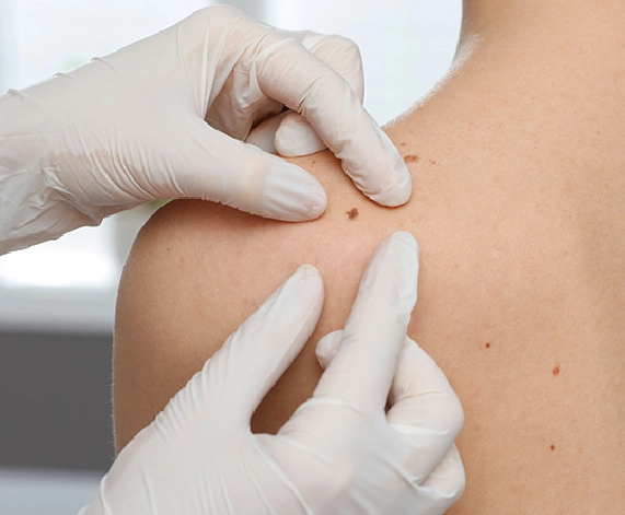 What is Mole Removal?